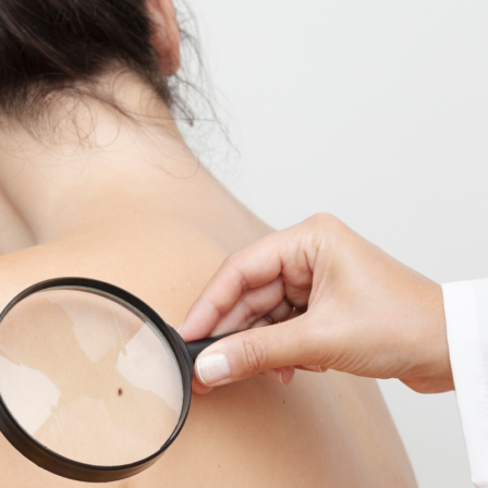 skin cancer skin cancer